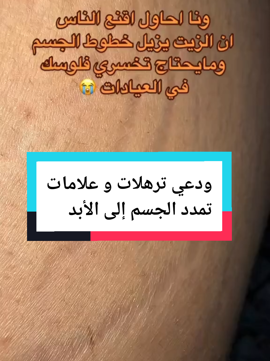 ودعي ترهلات الجسم وعلامات تمدد بعد الولادة بهذه الوصفة🌸 #اكسبلور #foryou #سيلوليت  #ترهلات #تمدد 