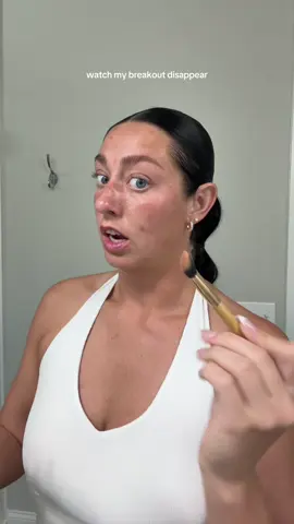 it’s actually magic on my breakouts and redness #skin #breakout #colorcorrector #viralproducts 