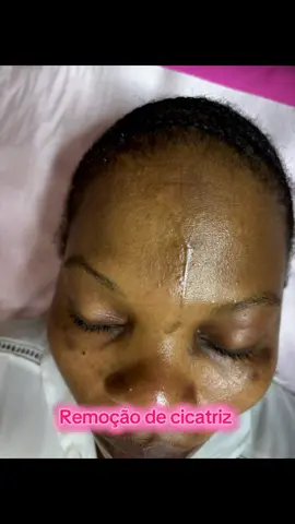 ✨ Remoção de Cicatriz a Laser ✨ A tecnologia do laser chegou para transformar a pele e devolver a autoestima! 💫 Com o tratamento a laser, conseguimos suavizar cicatrizes, estimular o colágeno e melhorar a textura da pele, deixando-a muito mais uniforme e bonita. 🌿 Cada sessão é personalizada de acordo com o tipo de cicatriz e o tom de pele — e os resultados são visíveis desde as primeiras sessões! 💥 📍 Mil Vibrações – Kilamba, edifício R9, porta 3 📞 930 919 360 / 956 759 075 #LaserCO2 #RemoçãoDeCicatriz #EstéticaAvançada #MilVibrações #BelezaComTecnologia  