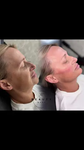 Some of my recent creations 😏😮‍💨🤌🏽#fyp #girlssupportgirls #aesthetics #fillers #facelift 