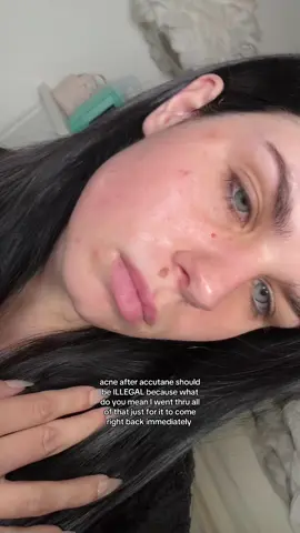i’m so freaking upset it’s all coming back i can legit feel it under the skin too. #accutane #realskin  #acne #acneproneskin #relatable 
