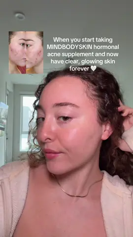 Saved my skin forever after nothing else worked 🥹❤️ #acne #acnetreatment 