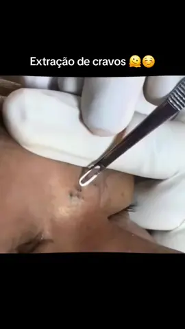 Extração de cravos  #videossatisfatorios #limpezadepele #foryoupage #cravoseespinhas #cravosgigantes 