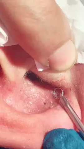 #basemkhaled123 #ازالة_رؤوس_السوداء #blakhead #whiteheads 