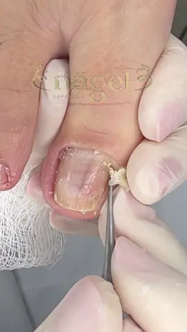 Você não vai acreditar o que aconteceu ali! #satisfying #nails #nagelpodologia #foryou #fyp