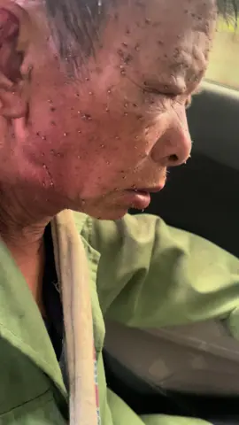 Cả tổ đốt thương bố thanh niên cũng bị đốt còn k chảy được huống chi người già , còn nguy cơ phải chạy thận nữa tiền ăn cũng chưa đủ tiền đâu mà chảy bố ơi 