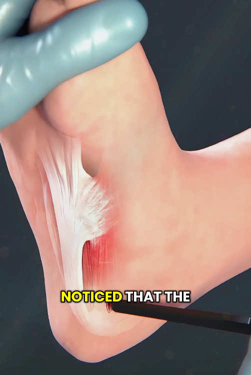 Plantar Fascia Release Surgery (3D Animation) #footsurgeon #footsurgery #plantarfasciitis #plantarfascia #plantarfasciitisrelief #plantarfascitiis #plantarfasciasurgery #medical3danimation #3dmedicalanimation