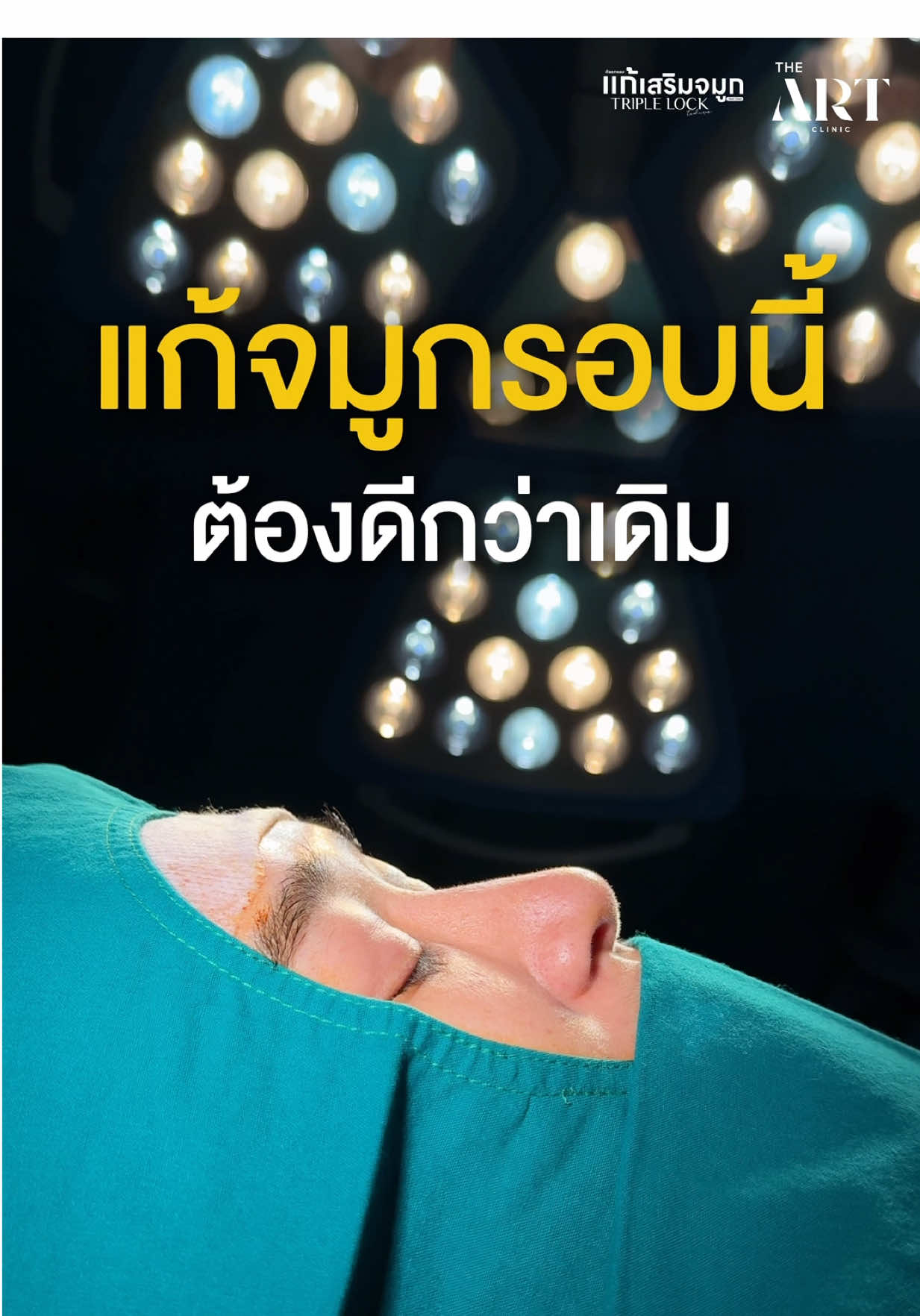 แก้รอบนี้ ต้องดีกว่าเดิม 😄  #theartclinic #เสริมจมูกดิอาท #เซมิโอเพ่น #ทรงจมูกยอดฮิต #หมอมีนดิอาท 