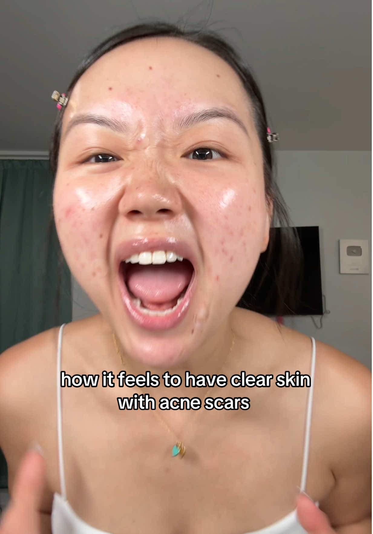 Idc acne scars are HOT 🤭💅 #acnescars #acnepositivity #clearskin 