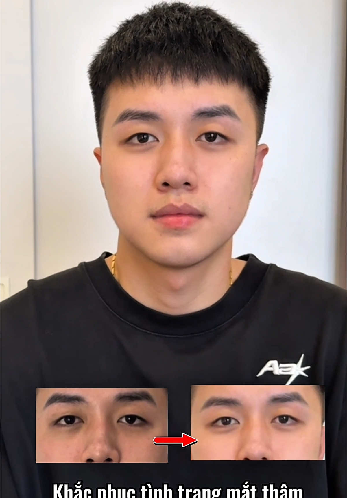 #filler #botox #ducmanh 