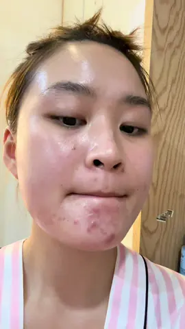 Da nhiều dầu quá thì mình dùng serum gì ? 🤔😬🤩 #rinabeauty #viral #byebyeblemish #niacinamide #kiemdau 