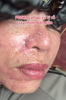 Phương pháp xử lý rỗ đáy nhọn đơn giản #lamdepjmoingay #yodyphuonganhphuxanhtoancau #spa #nam #tannhang 