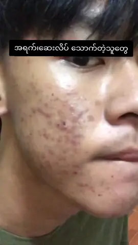 #ဝက်ခြံပျောက်ချင်သူများအတွက် #သလဲသီးမျက်နှာသစ်ဆပ်ပြာ #hcproductsလက်လီလက်ကား #tiktokmyanmar #fpy 