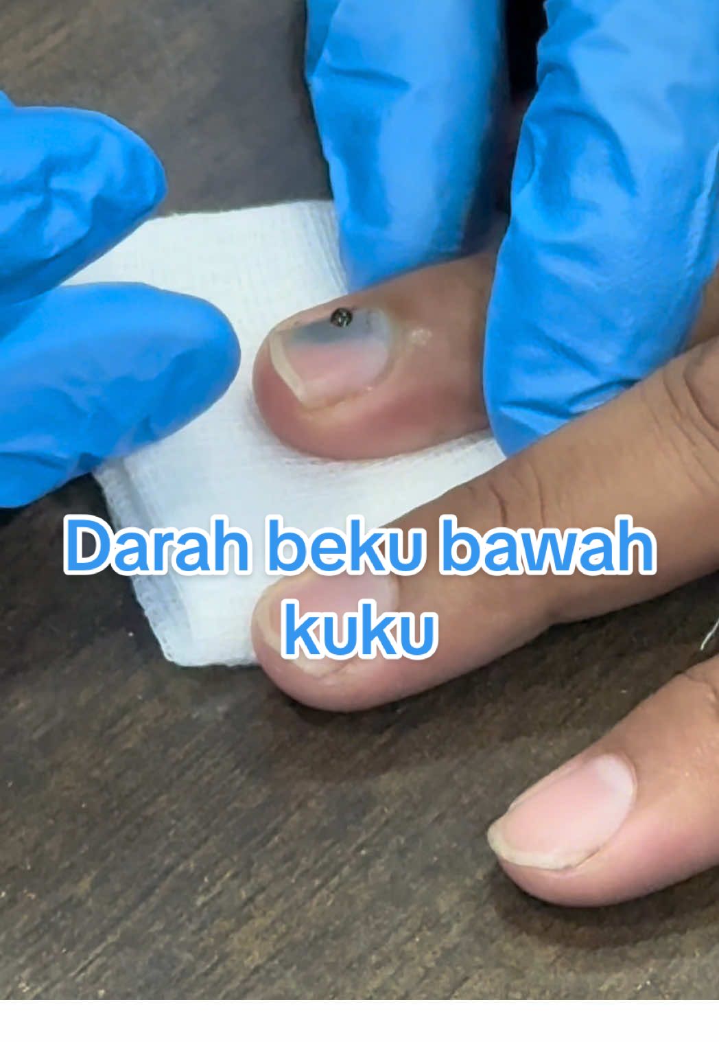 Darah beku bawah kuku memang sakit. Berdenyut nyut dia tu boleh bawak gaduh. 😤