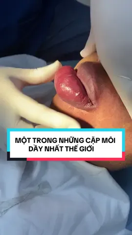 Một trong những cặp môi dầy và lớn nhất thế giới!  #Nhổ_răng_Khôn_Bs_Quý #Nhakhoa_Odessa_301_Thuỵkhue_TâyHồ #benhvienxanhpon #ktcxanhpon #videoviralitiktok @DR QUÝ - RĂNG SỨ - THẨM MỸ @DR LÊ QUÝ - LIFE STYLE @Niềng răng bác sỹ Mai Hương @Bs.Lê Trọng_RHM @Nhiiiii @NhakhoaOdessa_since2016 @Nguyễn Mai Hương 