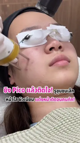 ยิง Pico แล้วติดใจ! รูขุมขนเล็ก หน้าใส ผิวเนียน แต่งหน้าติดจนคนทัก! #picolaser #timelessclinic #เทรนด์วันนี้ #ดันขึ้นหน้าฟีดที #fyp 