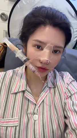 同一个女孩刚做完鼻子和一个月后的效果 #隆鼻 