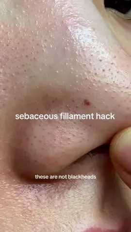 Sebaceous filaments cleansing tips You can’t completely remove them but can take care of it to make it look less apparent. Clay stick is from skin1004 (madagascar centella poremizing clay stick) #koreanskincare #skincare #skintok #sebaceousfilament #blackheads 