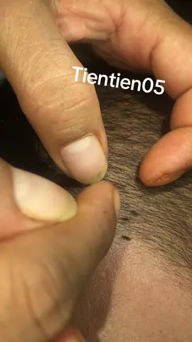 Remove lice 