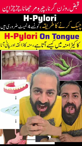 hpylori treatment, H-Pylori Cause, hpylori bacteria, hpylori on tongue, h pylori on teeth, hpylori in mouth, hpylori test, test for hpylori, hpylori. allergy, skin allergy, free diagnosis.tongue diagnosis, nails diagnosis, eyes diagnosis, urine diagnosis. #hpylori #hpyloriawarness #hpyloritreatment #skincare #diagnosis 