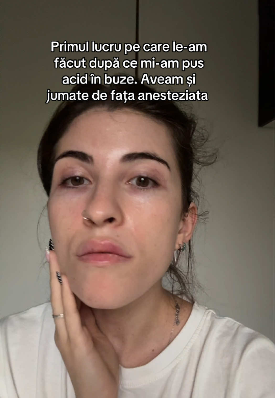 Am băgat 0,5 ml la @Dr.Elys #lipfiller #caterinca 