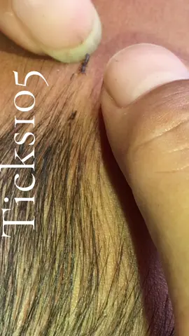 Remove lice #😱😱😱omg #😭😭😭 #😂😂😂 #liceremoval #🥶🥶🥶 