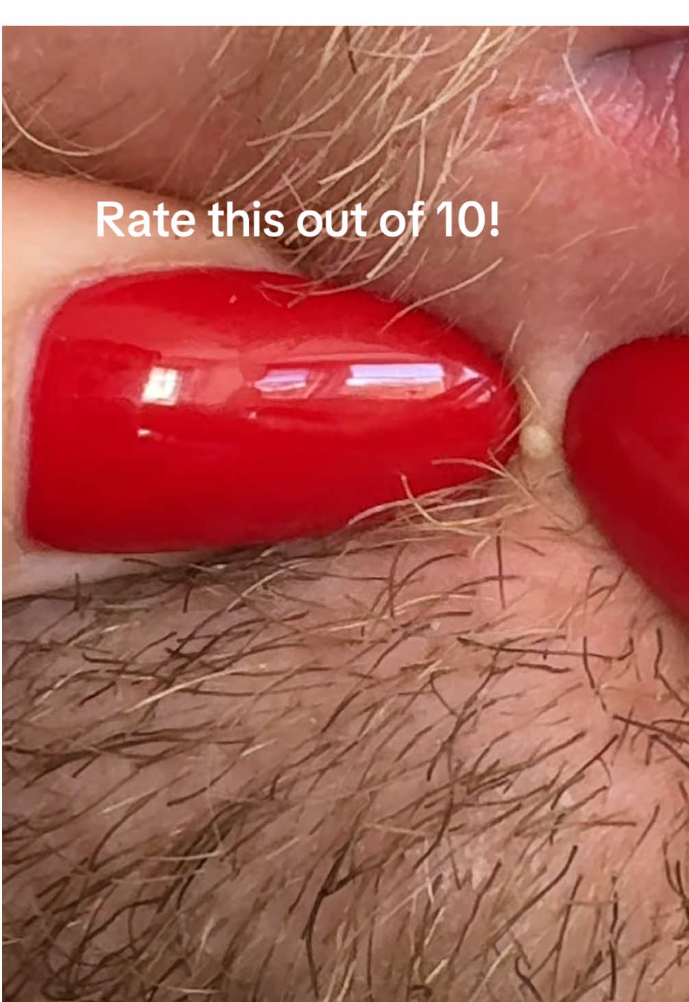 Squeeze this pimple with me.#satisfyingvideos #pimples #spotpopping #pimplepopper #pimpleasmr 