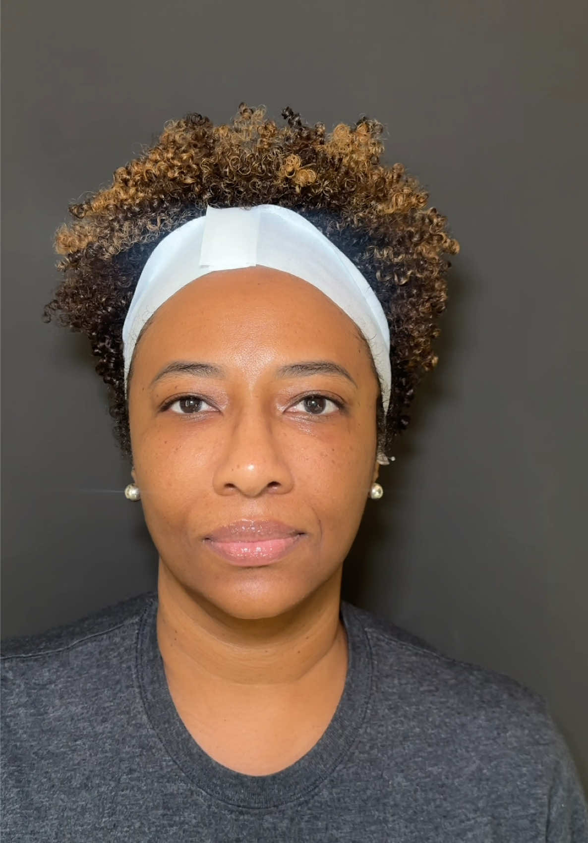 Facelift transformation 🥰 