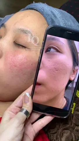 Cập nhật Sẹo#nanmunbangtambong#chamsocdaseo#chamsocda#chamsocdamun#chamsocdanam     