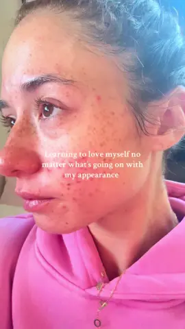 The past year has been so hard on me since I’ve never ever really struggled this much with my skin. I’m such a confident person and acne has made my light dwindle a bit. Despite all of it I am still beautiful and you are too! I just got back from the dermatologist And I’m gonna start spirno. #acne #acnetreatment #dermatology #dermatologist #acnestruggles 
