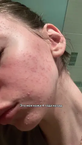 То, что помогло мне: #WW181379 вб (копируйте с букв WW)🤍 Сыворотка из видео🙏 #сыворотка #прыщи #гладкаякожа #уходзакожей РП