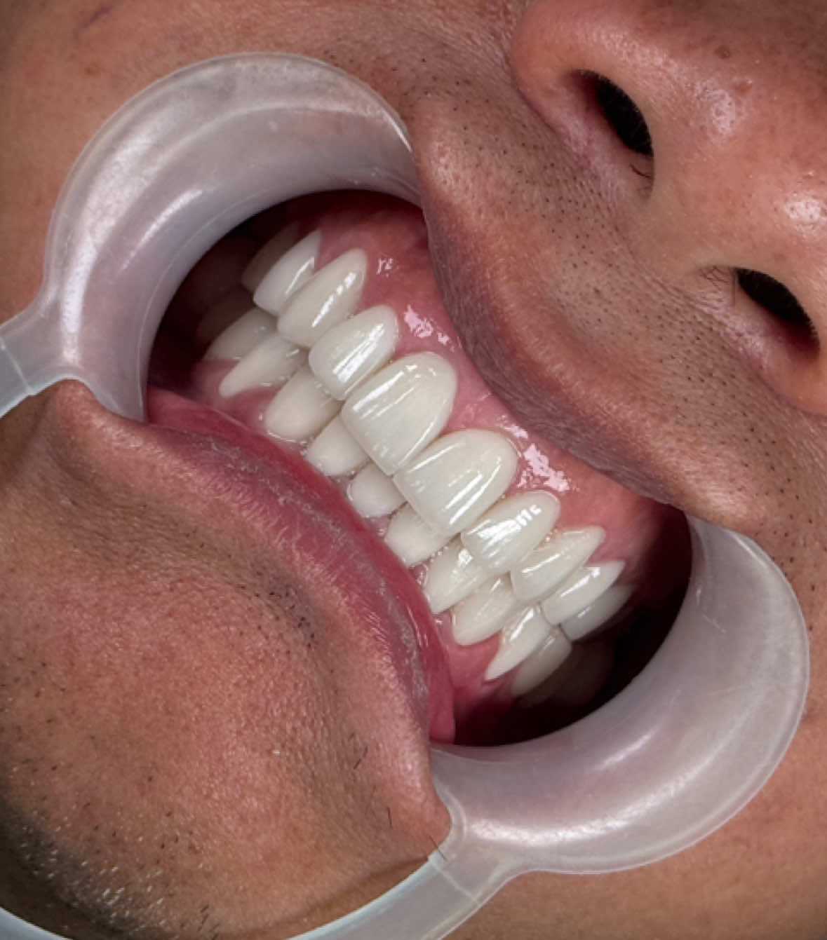 Veneer – Giải pháp thẩm mỹ hiện đại 💎 Giúp bạn tự tin với nụ cười hoàn hảo, mà vẫn bảo tồn mô răng thật tối đa 🦷 #veneer #nhakhoauytin #rangsuthammy #nhakhoa #xuhuong 