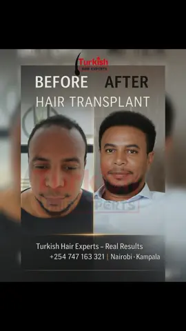 Same Face. New Confidence. This is what real transformation looks like !  Your journey from hair loss to full natural hair starts here 👇🏽 📍Turkish Hair Experts  Real Results in Nairobi & now Kampala 📞 +254 747 163 321 #hairtransplant #beforeafter  #hairtransformation #nairobitiktokers  #somalitiktok 