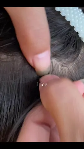 😱😱😱#omg #lice #liceremoval 