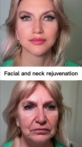 No compromise, no compromise, the pursuit of beauty never stops.#facelift #beautify #babyface 