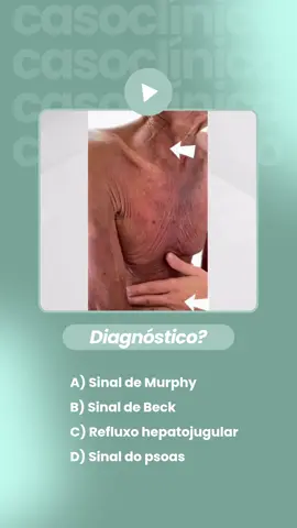 Qual sinal apresentado pelo paciente? . . . . . . . . . . . . . . . . . . . . . . . . C) O reflexo hepatojugular (também chamado refluxo hepatojugular) é uma manobra clínica utilizada para avaliar a pressão venosa central e a função do ventrículo direito, especialmente em pacientes com suspeita de insuficiência cardíaca. 🔹 Como é realizado: O paciente é colocado em decúbito semissentado (30–45°). Observa-se a veia jugular interna. O examinador exerce pressão firme e contínua sobre o hipocôndrio direito (região hepática) durante cerca de 10 a 30 segundos. Observa-se então a resposta da veia jugular. 🔹 Resultado: Normal: a pressão venosa jugular pode aumentar levemente (≤3 cm de água) nos primeiros segundos, mas retorna rapidamente ao nível basal enquanto a pressão é mantida. Reflexo hepatojugular positivo: a pressão jugular aumenta mais de 3 cm de água e permanece elevada durante toda a manobra. 🔹 Interpretação clínica: Um reflexo hepatojugular positivo indica que o coração direito não consegue lidar com o aumento do retorno venoso proveniente do fígado, o que sugere: Insuficiência cardíaca direita Insuficiência cardíaca global Doença pericárdica constritiva Miocardiopatias restritivas 🔹 Fisiopatologia: Ao comprimir o fígado, há um aumento do fluxo sanguíneo em direção à veia cava inferior. Em condições normais, o ventrículo direito acomoda esse volume adicional sem elevação significativa da pressão venosa. Por outro lado, se o ventrículo direito estiver congesto ou não complacente, a pressão venosa central se eleva e isso se reflete em uma distensão visível da veia jugular, caracterizando o reflexo hepatojugular positivo. Se você quer ter acesso a mais conteúdos como este, segue o perfil @leticia.llp #medicalstudents #medicina #estudantedemedicina #estudantedasaúde #médico 