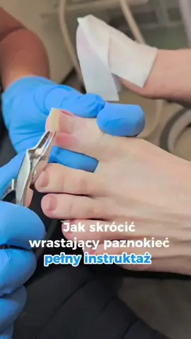 Wrastający paznokieć potrafi naprawdę dać w kość 😣🦶 W tej rolce pokazuję jak prawidłowo go przyciąć, żeby nie pogłębić problemu i przynieść stopie ulgę. ✂️ Bez zaokrągleń, bez kombinowania — spokojnie, precyzyjnie i skutecznie. Twoje stopy Ci za to podziękują 💛 #wrastającypaznokieć #podologia #zdrowestopy #paznokcie #gdansk 