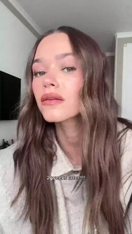 The 24/48h of redness is worth the glowwww - trust me 🤝🏻 #microneedling