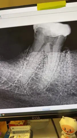 @Flexivo Dental #dentists #dentalstudent #dentalhygienist #rootcanal #dentalofficelife 