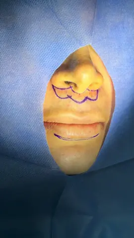 El lip lift es un procedimiento mínimamente  invasivo que produce una importante mejoría estética, devolviendo la apariencia juvenil y el volumen al labio. También permite exponer algunos milímetros más los dientes incisivos, lo que se considera un atributo de un rostro armónico. 👄  Tiempo del procedimiento: 30 minutos  Anestesia : local  Teléfono ☎️ 🇨🇴 +57 (300)1799663 🇺🇸+57(318)7372849 . . . . . . . . . . . . . . .  #lipopapada #bichectomía #medellin #cartagenadeindias #calicolombia                    