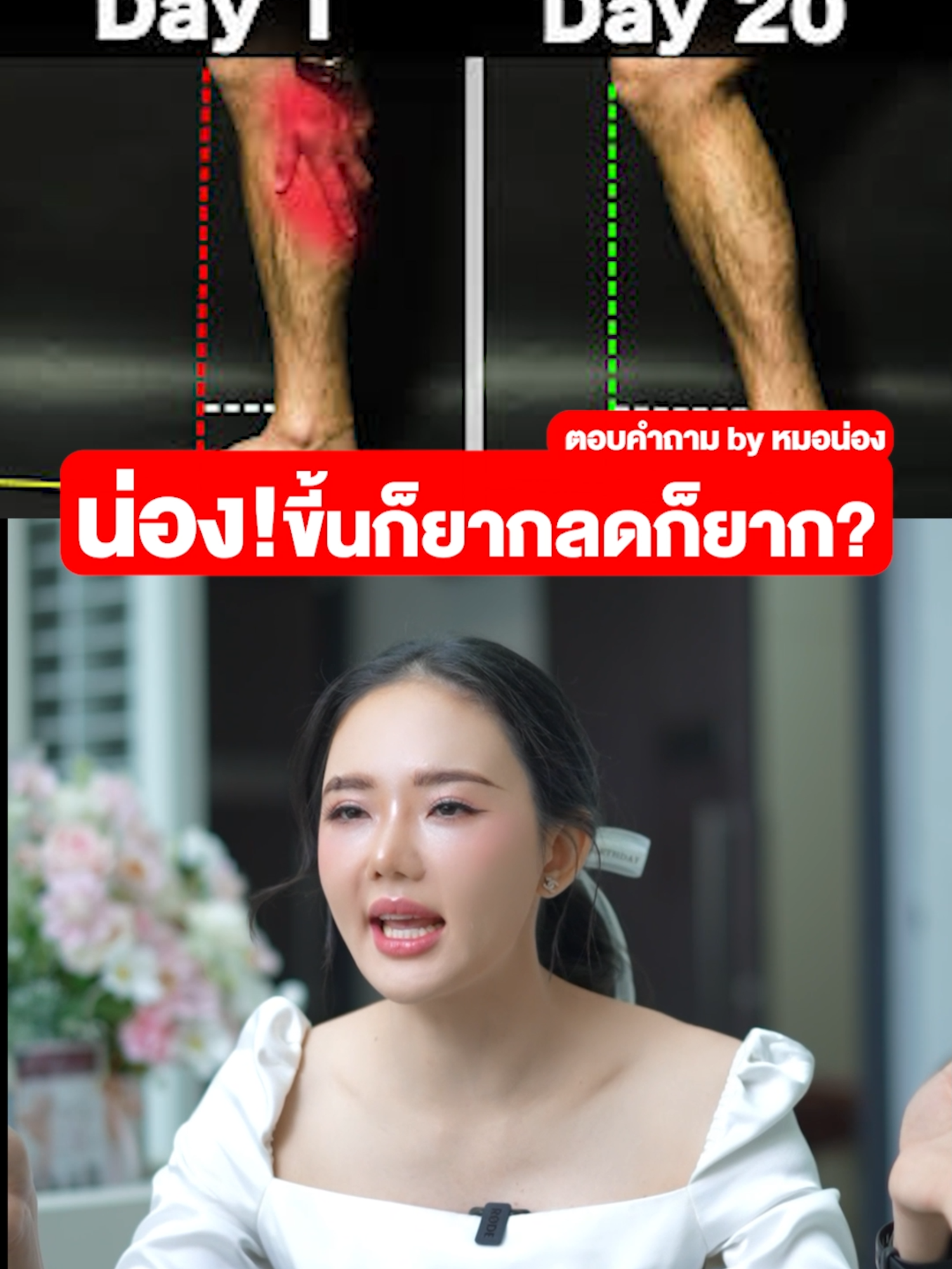 ถ้าอยากลดมาหาหมอนะ#หมอน่อง #หมอปี #estiqueclinic #กล้ามเนื้อ #ขาใหญ่ #หน่อง #หน่องใหญ่