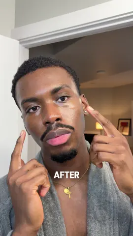 7 days in and my dark spots are already lighter. Zero irritation and it’s dark skin friendly! ~ Products: @Jumiso Official  ~ #jumiso #niacinamide #darkspotremover #hyperpigmentation #skintransformation 