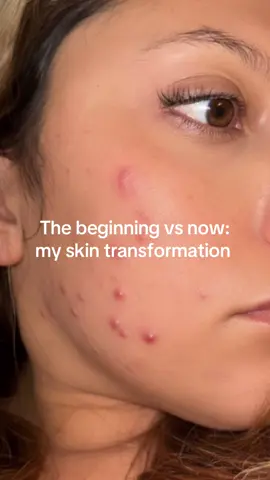 1 month update!! Skin is more even, pores feeling clean and looking smaller. No new acne! I like the cooling feeling and how clean I feel. 