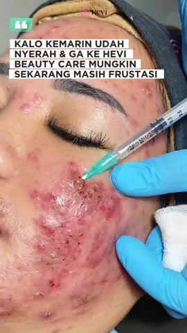 Buktikan sendiri hasil treatment di hevi beauty care😳‼️ 📍Hevi beauty care pusat pontianak Jln hm suwignyo no 18A-B kec sui bangkong, pontianak kota, kota pontianak. Kalbar (di samping lapangan futsal) Google map : hevi beauty care pusat Wa 0858-2179-6686