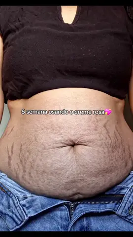 Increíbles resultados✅😍 #adeus #brasil🇧🇷 #colombia #antiestrias #celulitis 