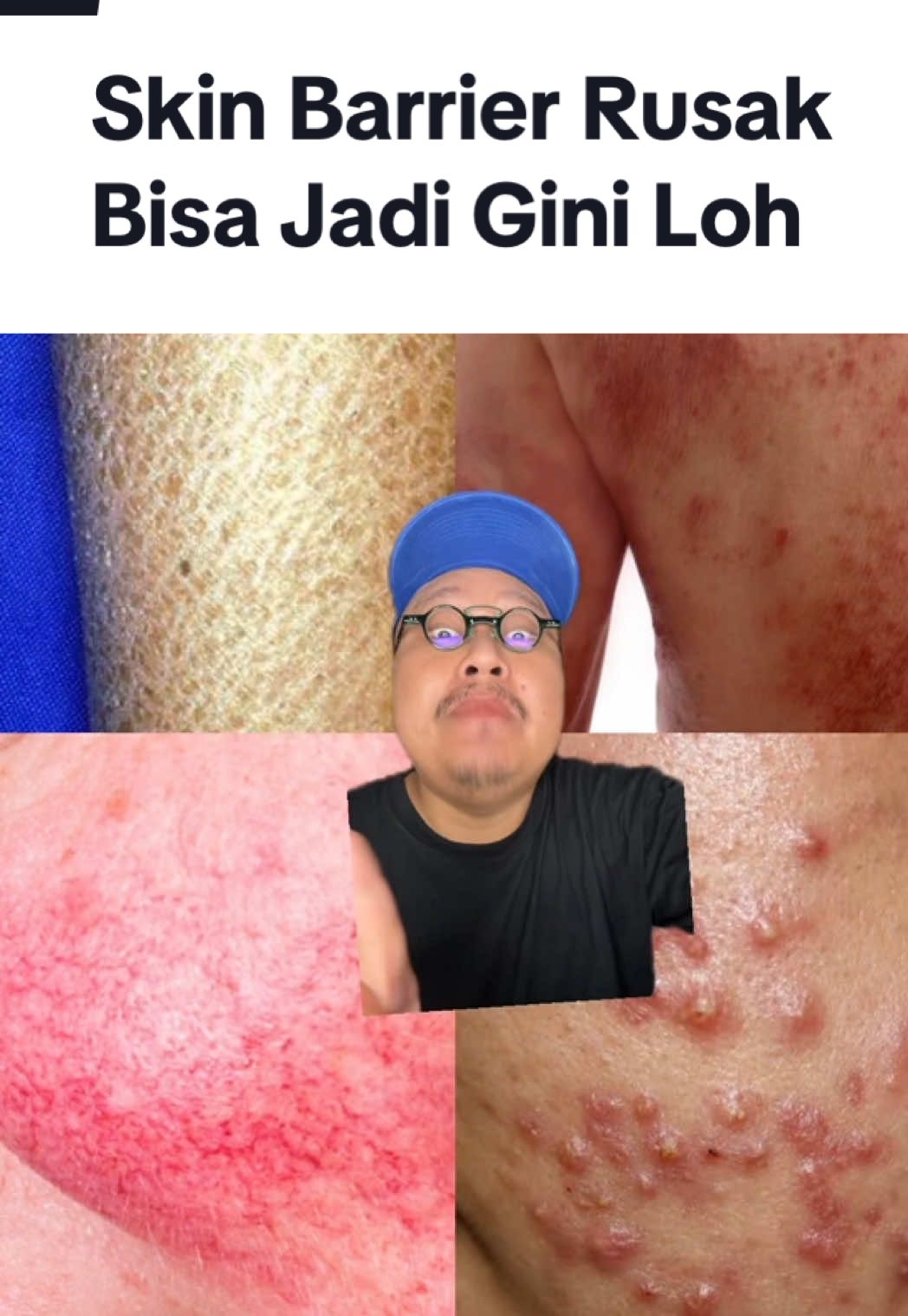 siapa yg kondisi kulitnya kyk di video gini akibat skin barriernya rusak ga dirawat? 🥲 #cicacovered #supermoisturizer #larocheposayid @La Roche-Posay Indonesia #skinlifechanger #cicacoveritall 