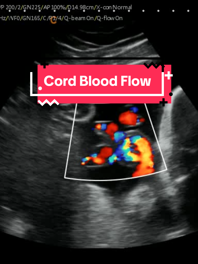 Blood Flow through the Umbilical Cord at 26 Weeks 5 Days Pregnant! #heybabymobile #cordbloodflow #rochesternyultrasound #pregnancyultrasound #mobilebabyultrasound www.HeyBabyMobile.com 