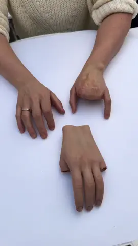 Prosthetic devices restore not just movement — but confidence, independence, and quality of life. 💪✨ Each prosthesis is carefully designed to match the body’s natural form, providing comfort, precision, and functionality for everyday use. Innovation and compassion come together to help people move freely again. 🌍❤️ #Prosthetics #MedicalInnovation #ArtificialLimbs #Rehabilitation #Mobility       