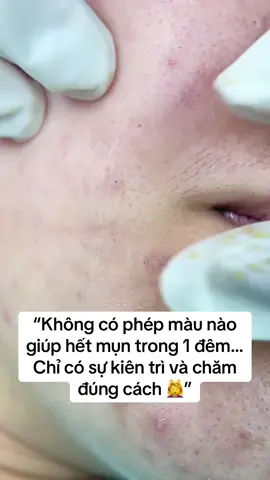 “Mụn không đáng sợ, bỏ cuộc mới đáng sợ 💪 #viralspa #skincarejourney #làmđẹpthật #fyp”