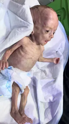 Welcome to Day 2 of Baby Naveed’s journey in the Neonatal Intensive Care Unit (NICU). In this video, we share an educational look at how NICU teams monitor and support newborns during their early days of life. On his second day, Baby Naveed is taking his feedings well — an important milestone in neonatal care. Feeding tolerance, vital signs, and temperature regulation are closely observed at this stage to ensure healthy development and stability. This video aims to raise awareness about what happens in a NICU during the early days after birth, and how healthcare professionals provide specialized care for newborns who need extra support. Topics covered in this video include:  • Day 2 NICU care routines and monitoring  • Feeding initiation and tolerance in newborns  • The role of nurses and doctors in supporting neonatal growth  • Family involvement and emotional support during NICU stay Whether you’re a parent, student, or healthcare professional, this video offers insight into the dedication and teamwork that help tiny babies grow stronger every day. 📘 Disclaimer: This video is for educational purposes only and does not replace medical advice. Always consult qualified healthcare providers for personalized guidance.  #babynaveed #malnutrition #malnourishedbaby #nicubaby #bottlefeeding 